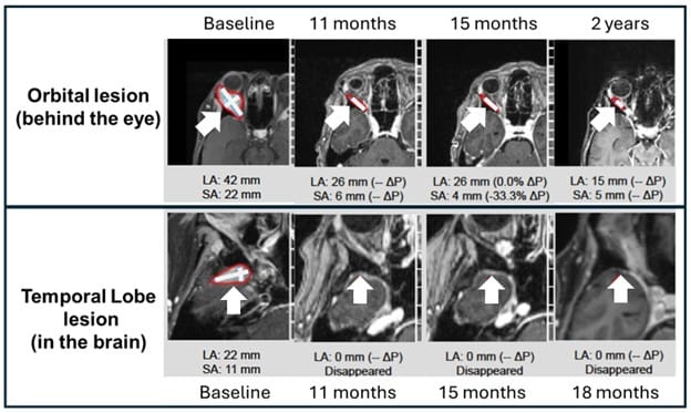 **Headline:** BriaCell Shares Imaging Data Showing Tumor Reduction in Metastatic Breast Cancer Patients