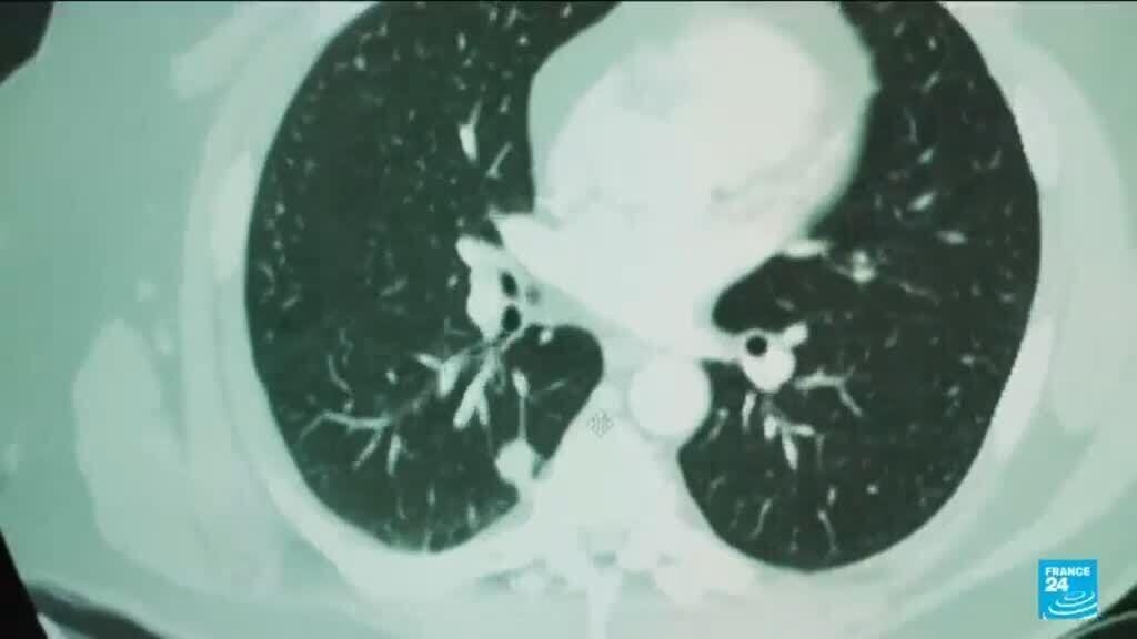 **AI Technology Enhances Breast Cancer Detection in Swedish Trial**